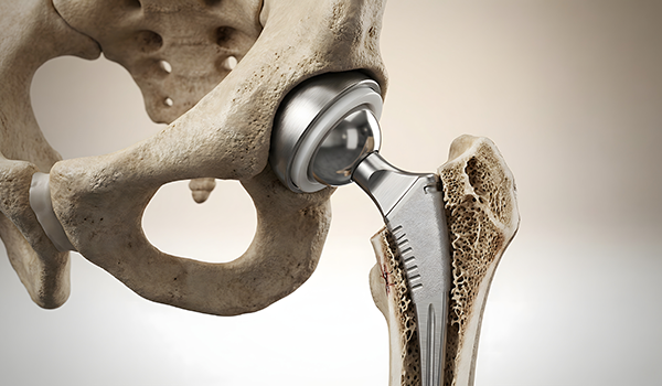 Total Hip Replacement In Dallas Total Hip Replacement In Dallas